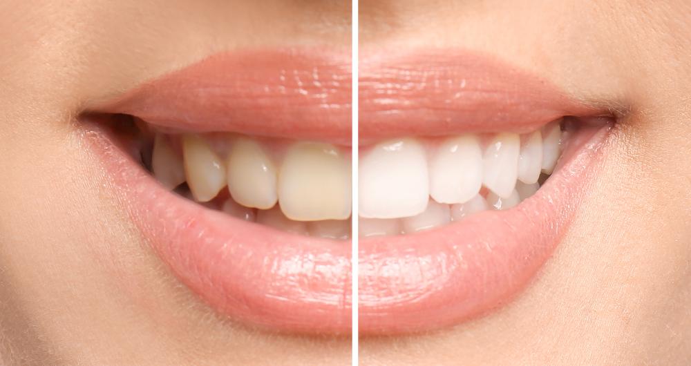 close up of teeth whitening before and after | teeth whitening parramatta