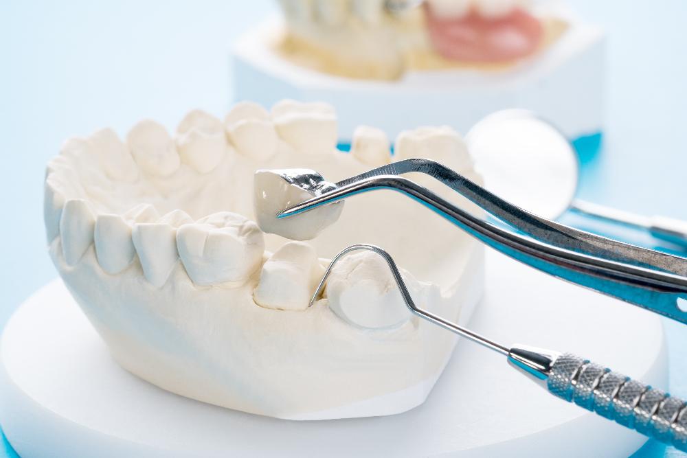 close up of dental tool and mouth mold | tooth extractions parramatta