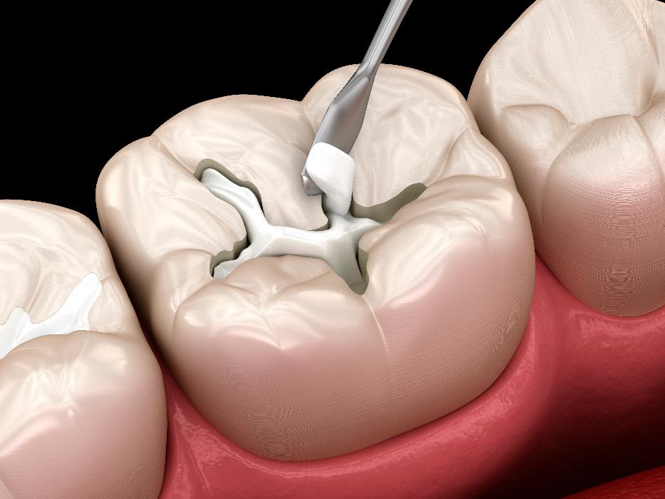 tooth getting filled | tooth filling parramatta
