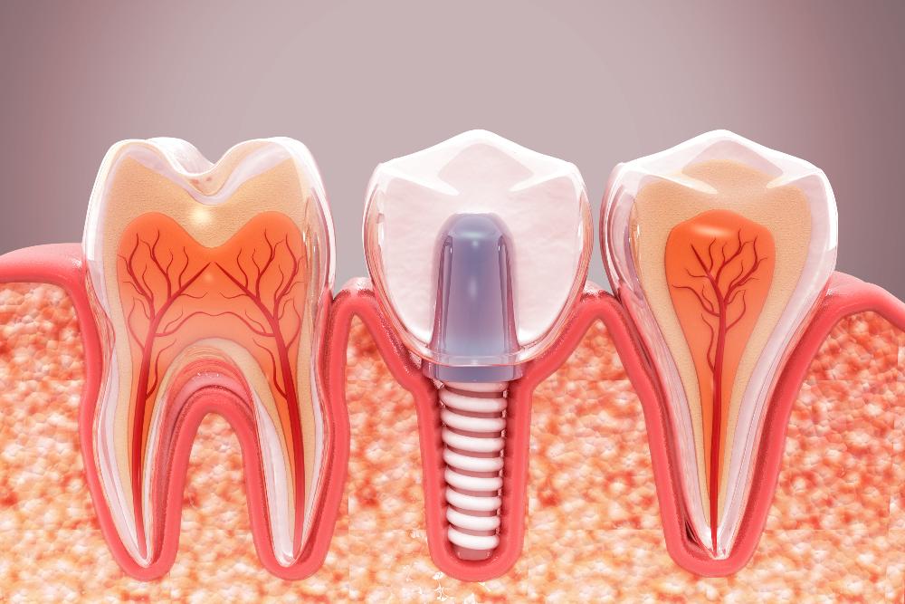 side view of dental implant in jaw | dental implants parramatta