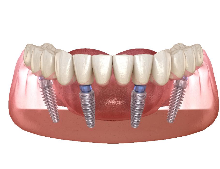 rendering of dental implants in jaw | dental implants parramatta