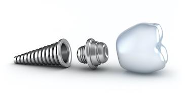 dental implant in three parts | dental clinic parramatta
