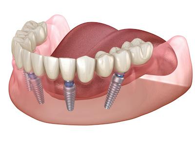 diagram of implant denture in parramatta