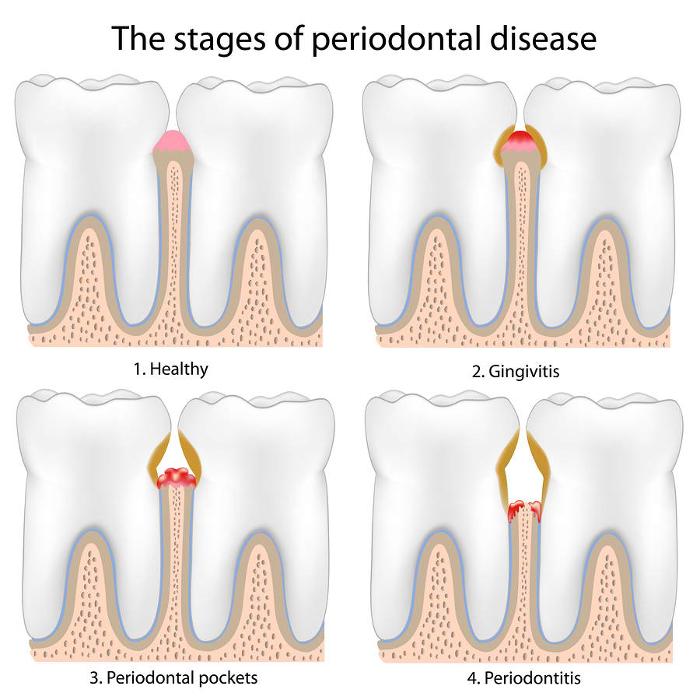 close up of gum disease infograph | dental clinic parramatta