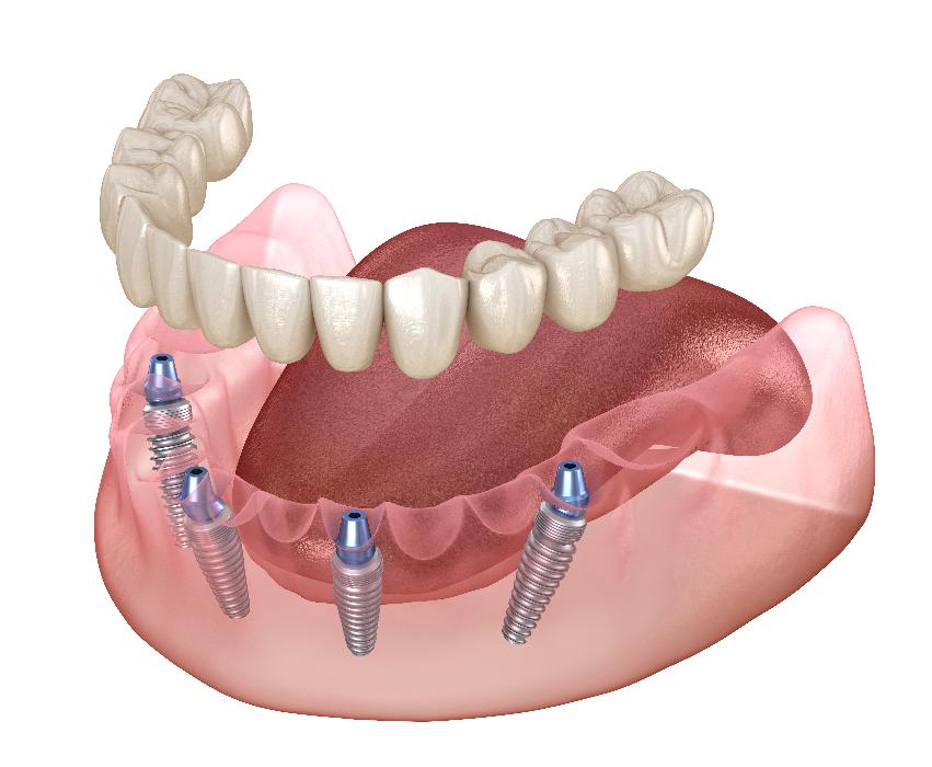 all on 4 implant bridge on lower jaw | dental implants harris park
