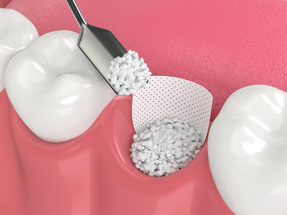 dental tool completing bone grafting process | bone grafting parramatta