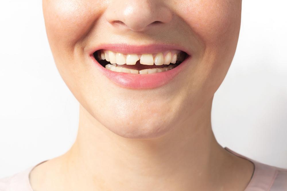 patient with chipped front tooth | dentist parramatta
