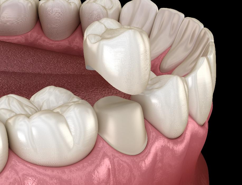 close up of dental crown | dental crowns parramatta