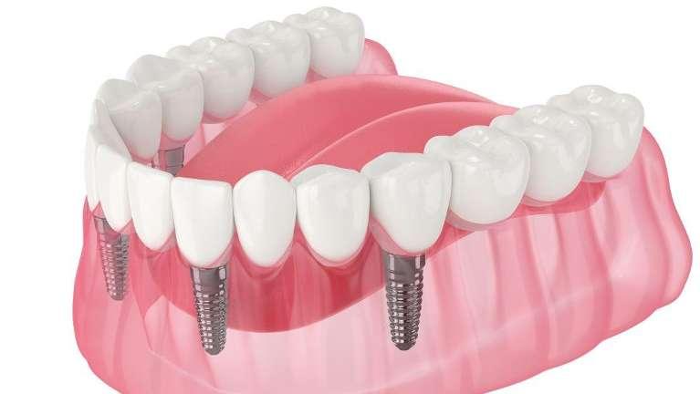 dental bridge on lower jaw | parramatta dentist