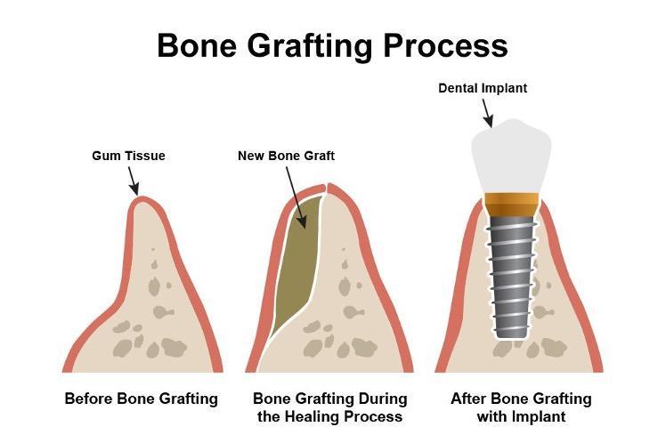 bone grafting diagram