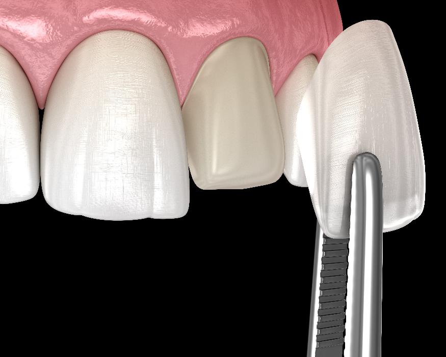 close up of veneer on tooth | veneers parramatta