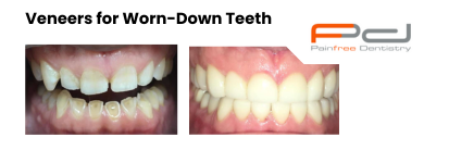 veneers parramatta | before and after worn teeth