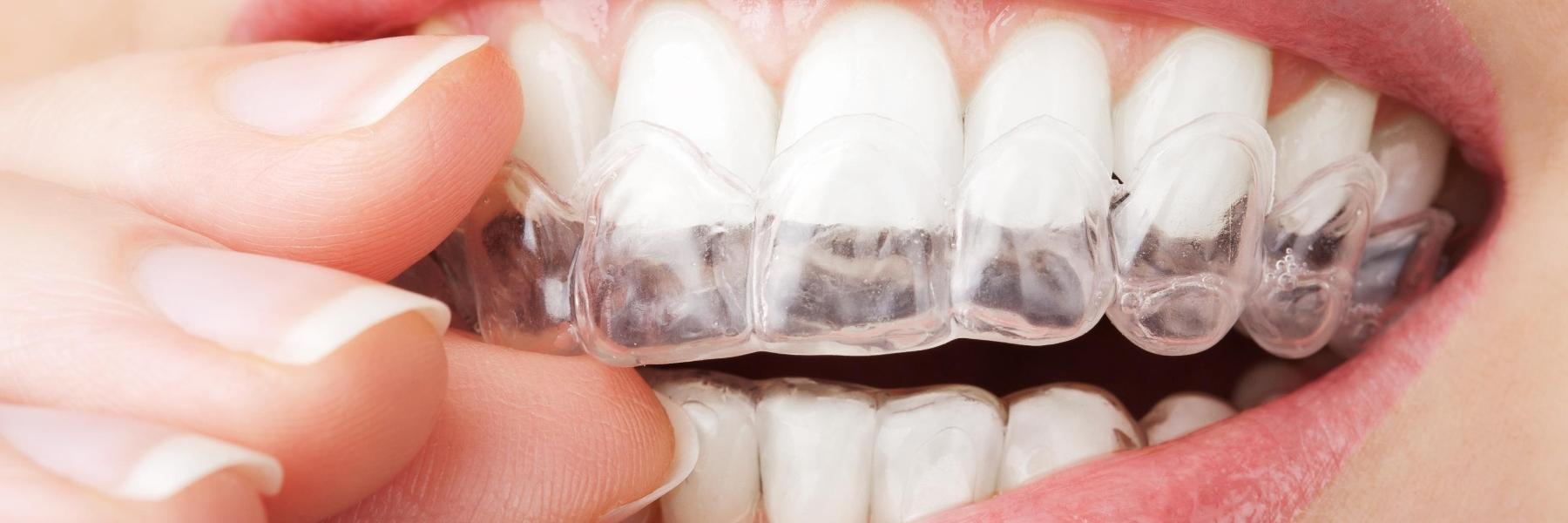 woman putting in invisalign in parramatta 