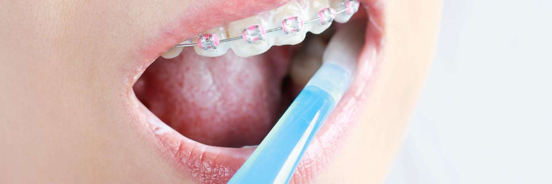Child with braces brushing teeth | Sydney Dentist