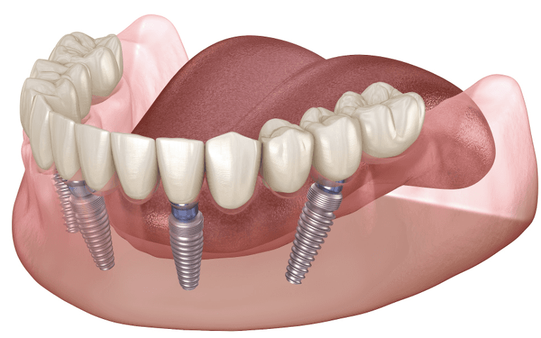 graphic illustrating all-on-4 dental implants