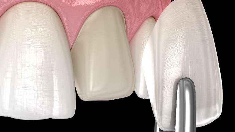 veneers parramatta | close up of dental veneer on tooth