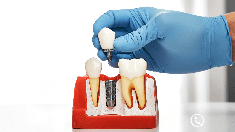 Dental Implant Diagram | Harris Park Dentist