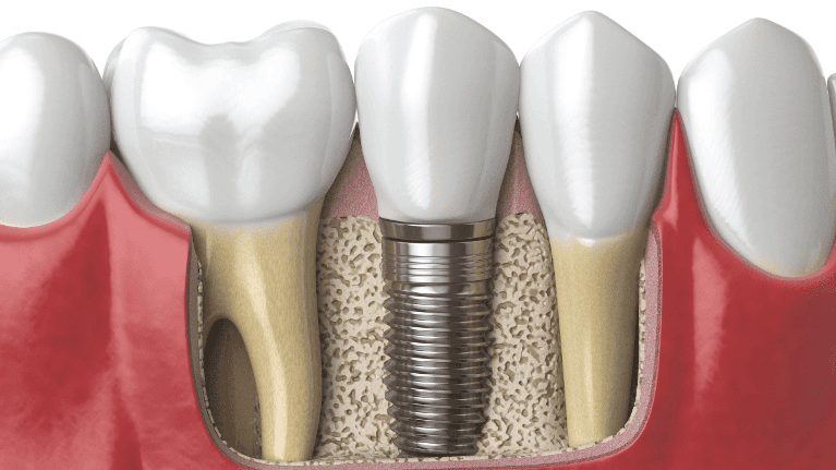 tooth replacement patient in parramatta nsw