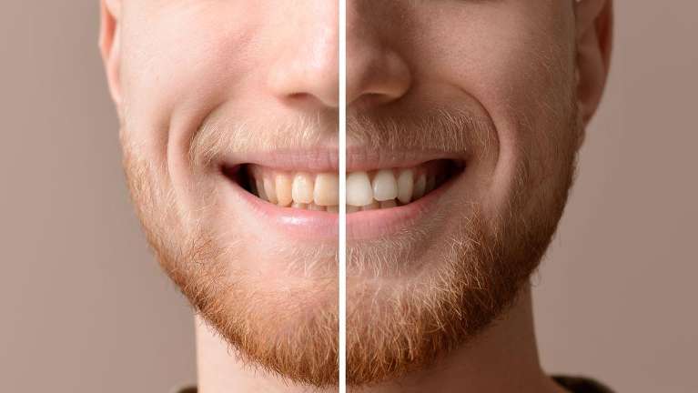 teeth whitening before and after image | teeth whitening parramatta