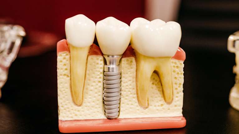 Diagram of how a dental implant works in Parramatta, NSW