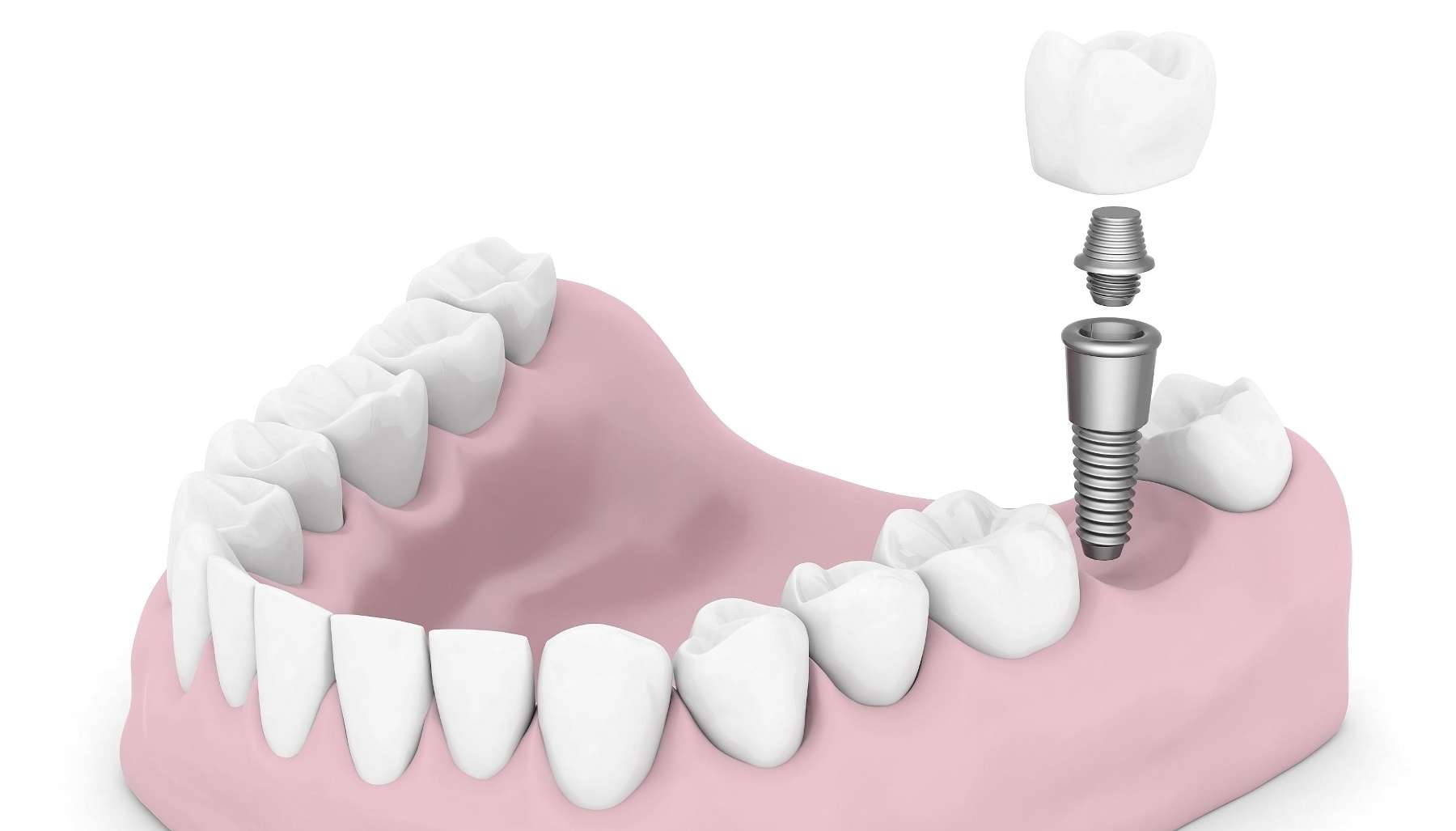 harris park dental implants