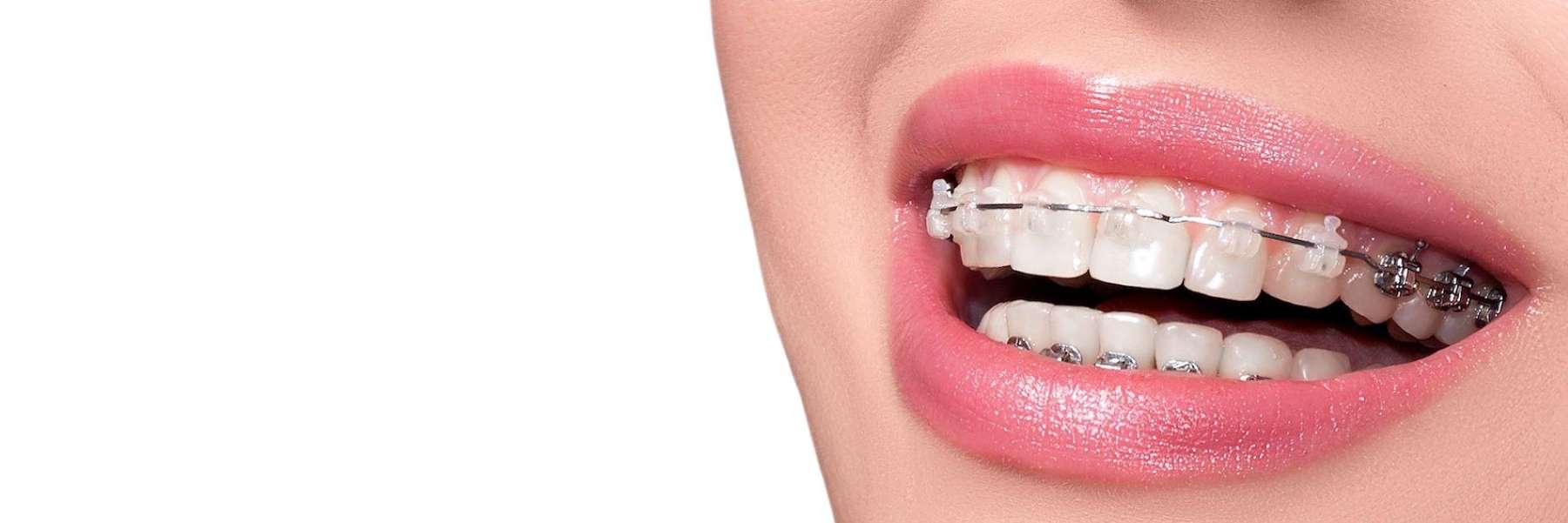 close up of braces in mouth | dentist parramatta nsw