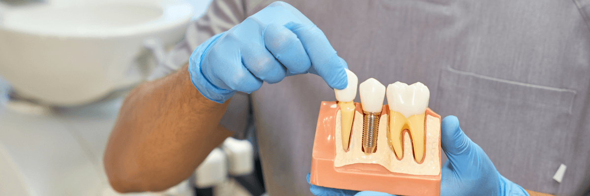 Dentist holding dental implant example in Sydney