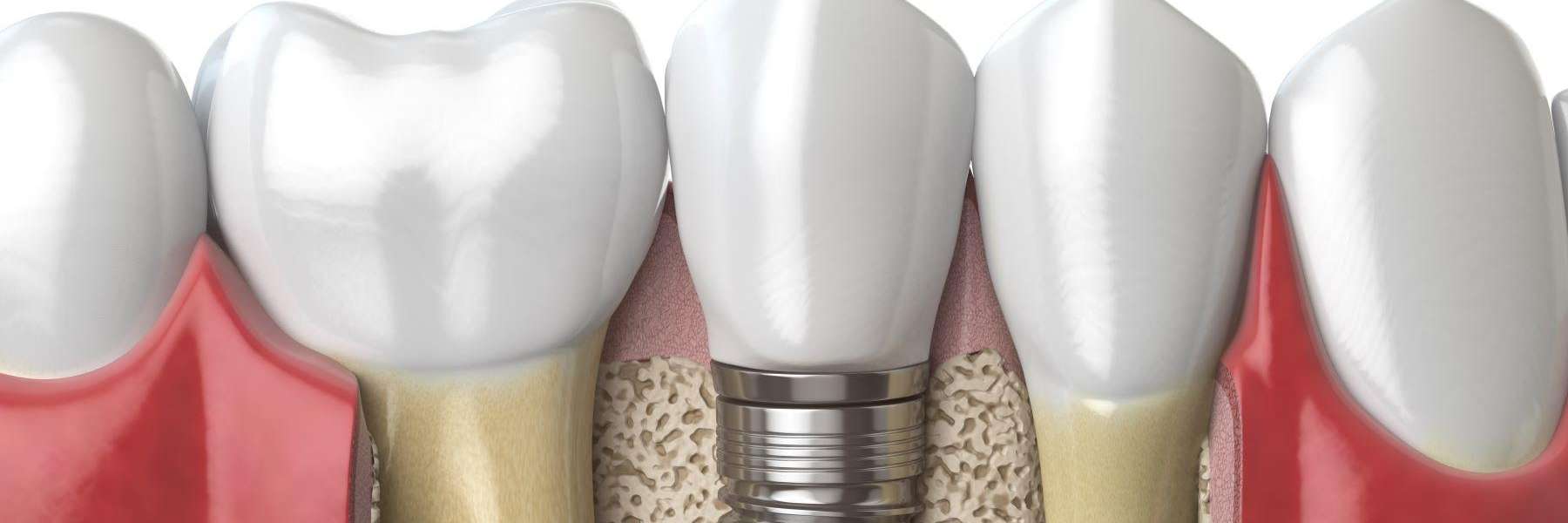 dental implant illustration | Parramatta