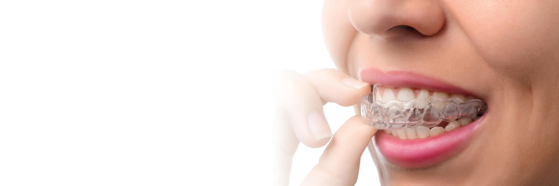 invisalign parramatta