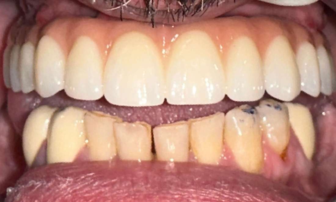 All On 5 Dental Implants After Photo