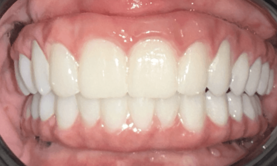 complete and bright smile after dentistry | cosmetic dentist parramatta