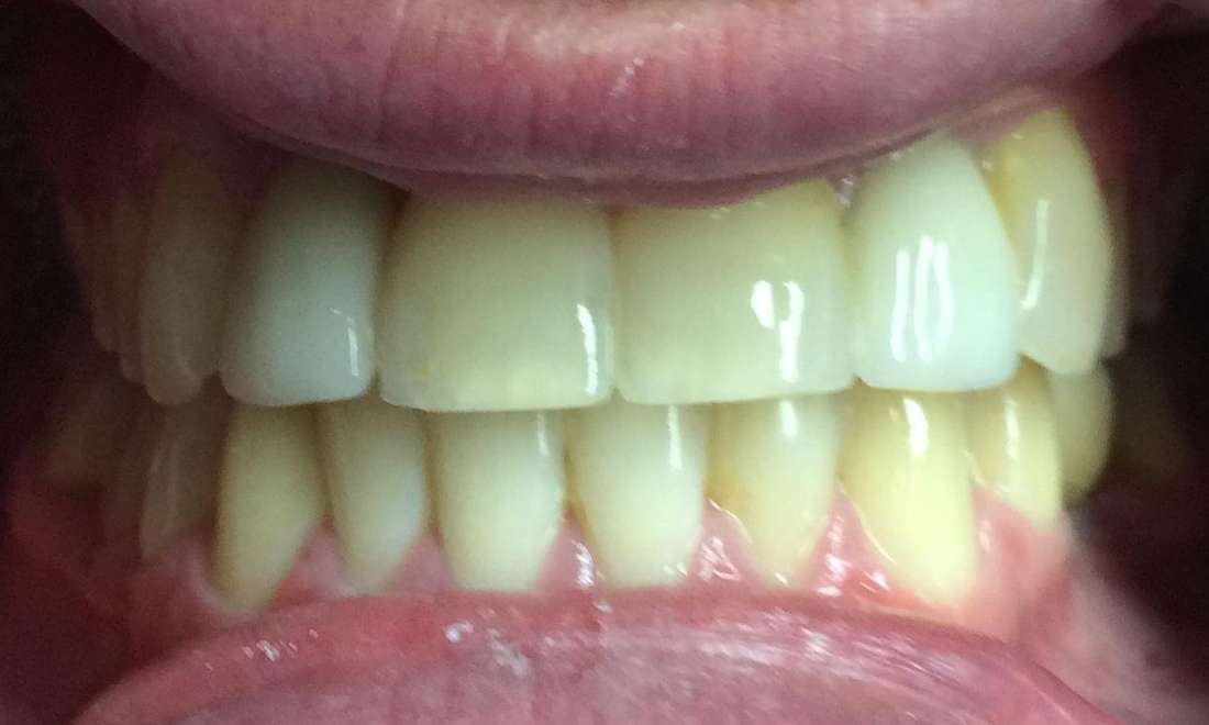 Orthodontics and Implants Before & After Photos Harris Park NSW