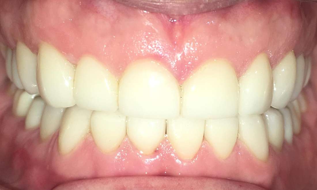 Patient with new veneers and a new smile | dental clinic parramatta
