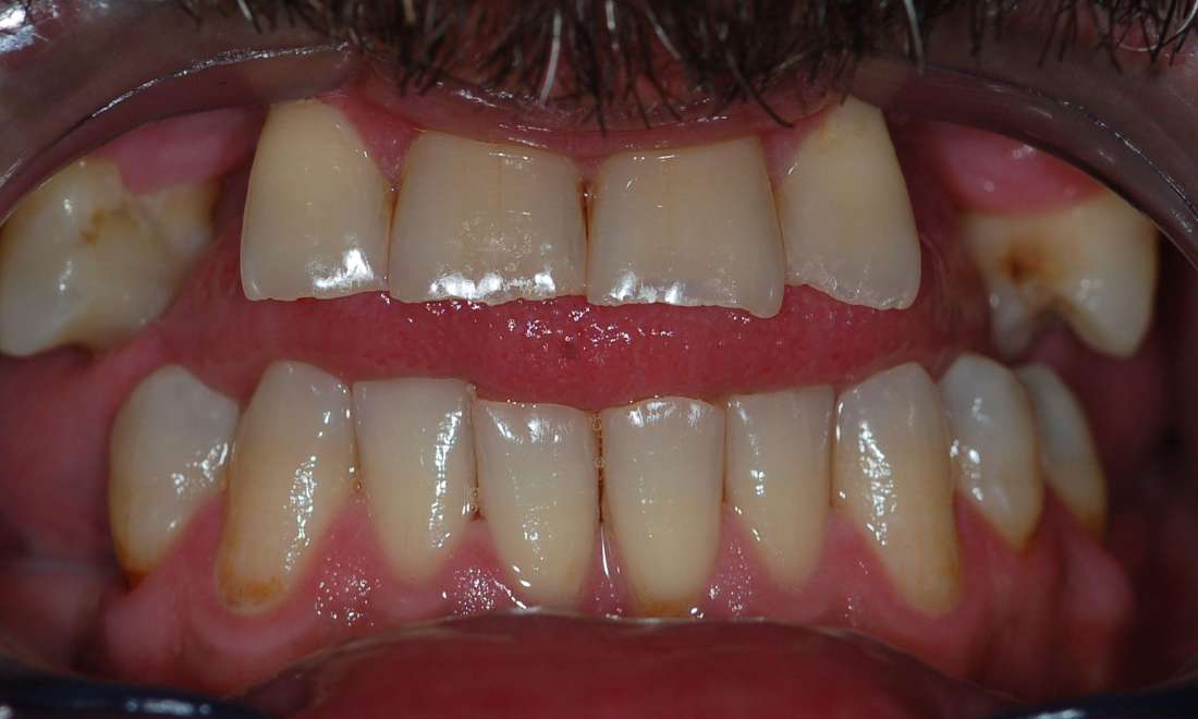 All On 5 Dental Implants Before Photo