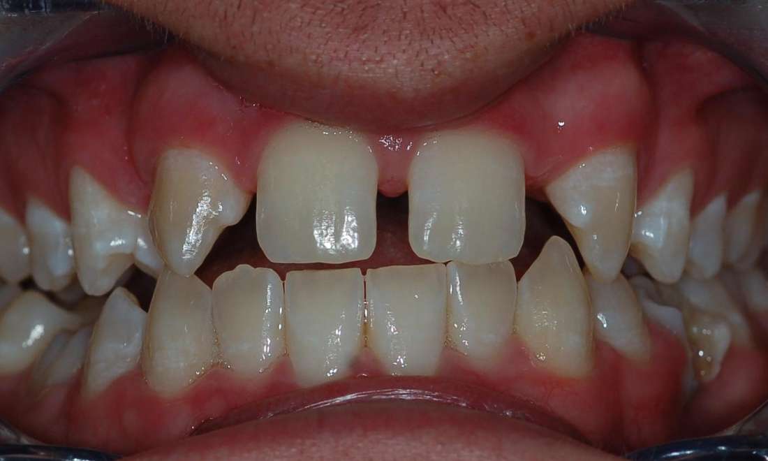 Orthodontics and Implants Before & After Photos Harris Park NSW