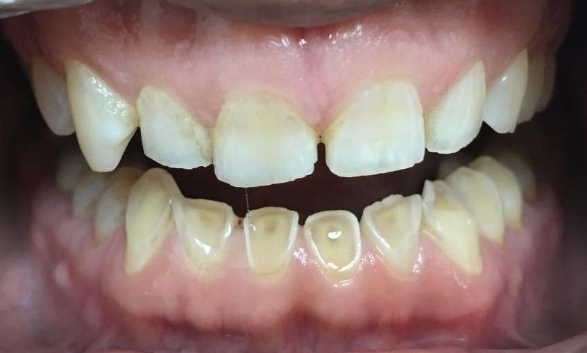 patient with worn teeth | Parramatta Dentist