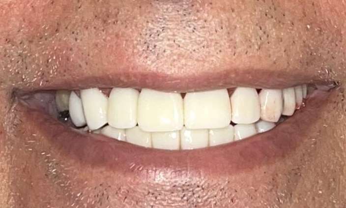 straight and full teeth after dentistry | parramatta dentist