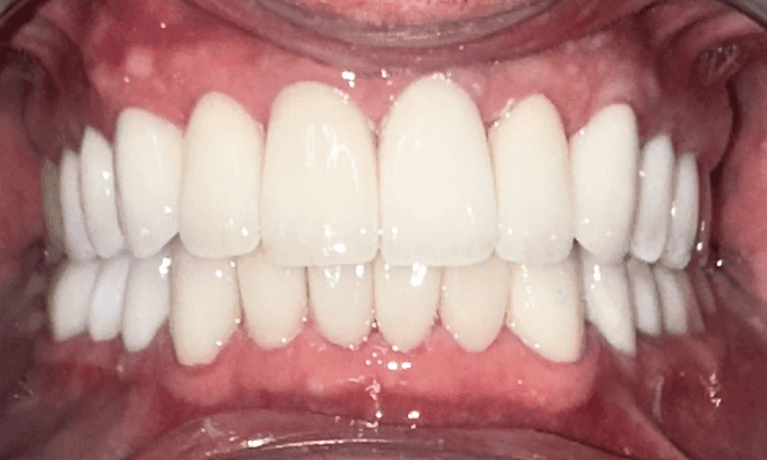 All-On-4-Implants-Before-and-After-After-Image