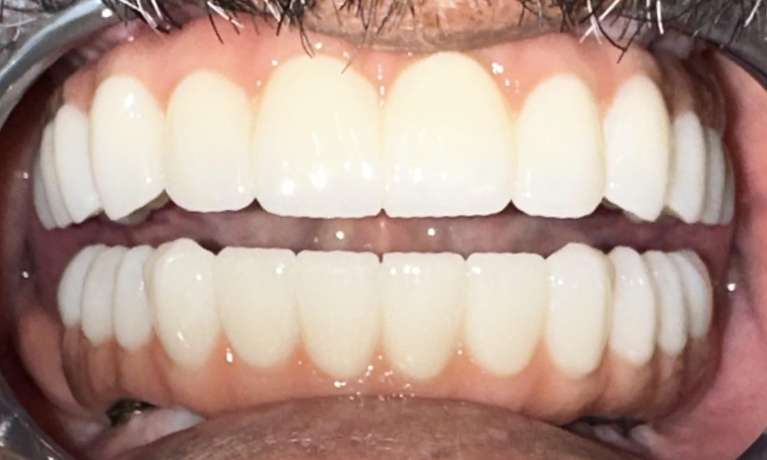 complete smile after dental treatment | full smile makeover harris park