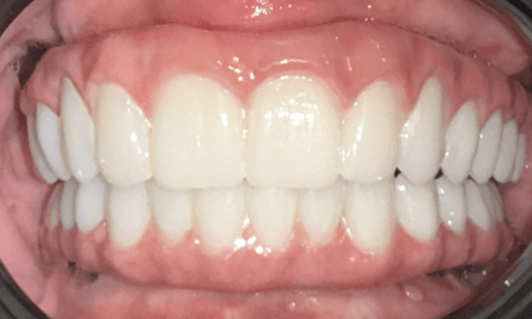 complete and bright smile after dentistry | cosmetic dentist parramatta