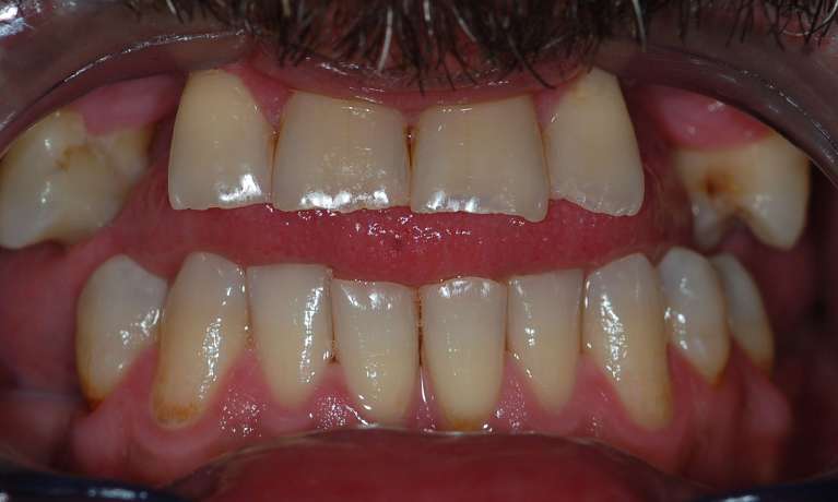 All-On-5-Dental-Implants-Before-and-After-Before-Image