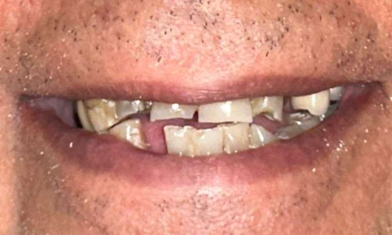 chipped teeth before treatment | dental clinic parramatta