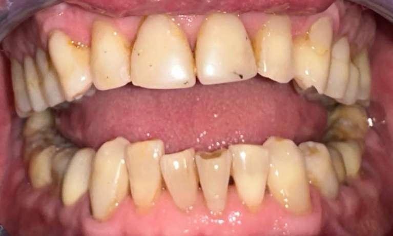 All-On-4-Implants-Before-and-After-Before-Image