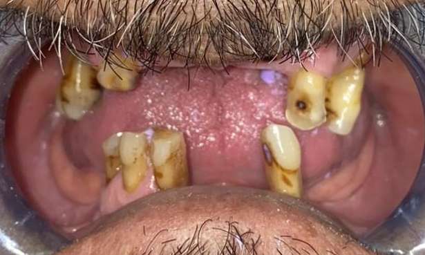 missing teeth before treatment | dentist parramatta