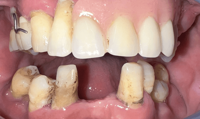 missing teeth before dental implants | dental implants harris park